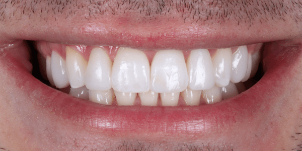 crowded teeth after Invisalign 