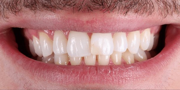 crowded teeth before Invisalign 